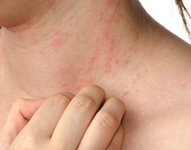 На что бывает аллергия в декабре?