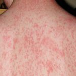 Аллергия на парацетамол: симптомы и чем заменить