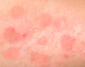 Аллергия на солнце: причины, симптомы и лечение