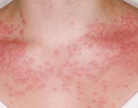 Аллергия на духи — может ли быть, симптомы и что делать