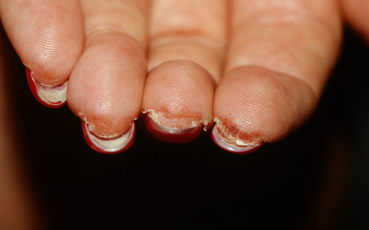 Пальцы при аллергии