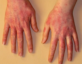 Аллергия на моющие средства: причины, симптомы и что делать