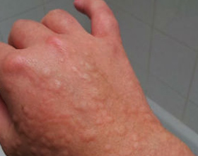 Аллергия в ноябре: симптомы и провокаторы