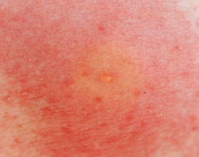 Аллергия на укусы ос: симптомы, причины и что делать