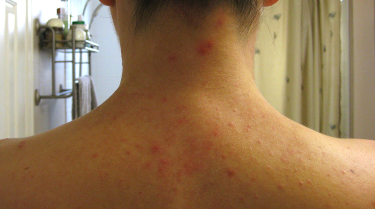 Аллергия на коже от шампуня