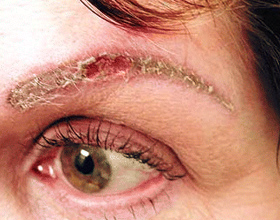 Аллергическая реакция на краску и татуаж для бровей: симптомы и что делать