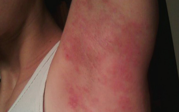 Аллергия от дезодоранта