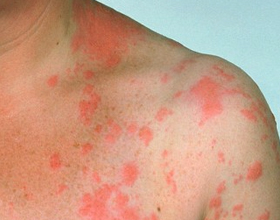 Аллергия на аскорбиновую кислоту — может ли быть, симптомы и что делать
