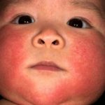 Аллергия на молочные продукты у ребенка: причины, симтомы и что делать