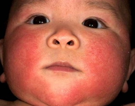 Аллергия на молочные продукты у ребенка: причины, симтомы и что делать