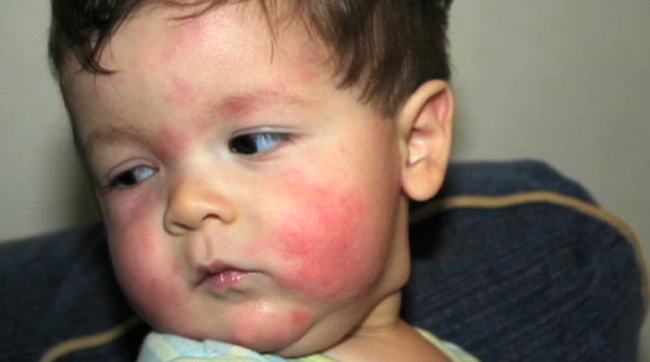 Аллергия у маленького ребенка