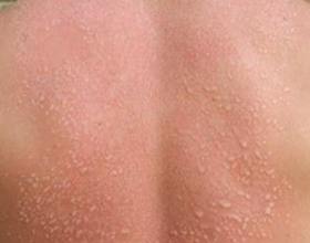Аллергия на хлорированную воду в бассейне: причины, симптомы и что делать