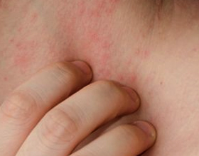 Аллергия на цитрусовые: причины развития, симптомы и лечение
