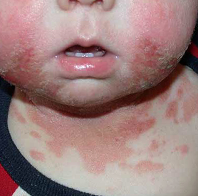 У малыша контактная аллергия