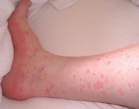 Контактная аллергия у ребенка: причины, проявления и лечение (с фото)