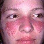 Аллергия на крем для лица: причины, симптомы и что делать