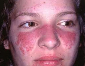 Аллергия на крем для лица: причины, симптомы и что делать