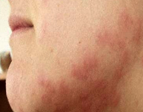Аллергия на пыль: виды, симптомы и что делать