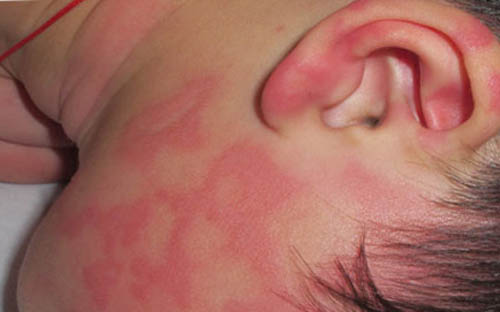 Контактная аллергия на лице и ушах