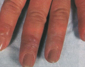 Аллергия на гель лак: причины, симптомы и чем лечить (с фото)