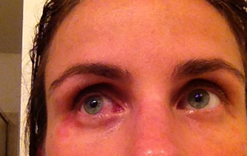 Аллергия на глазах