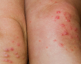 Аллергическая реакция на коленях: симптомы и что делать