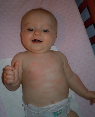 У малыша аллергия
