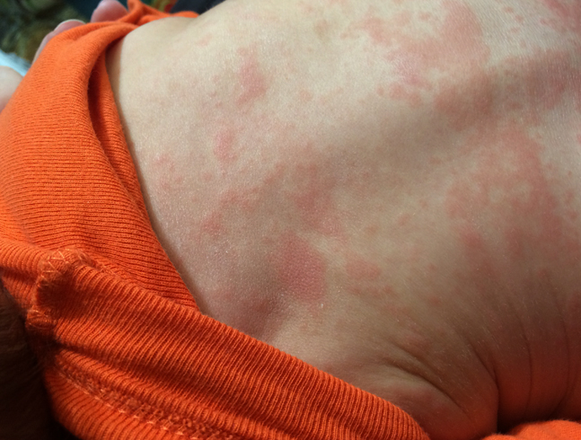 Аллергия от черники на коже