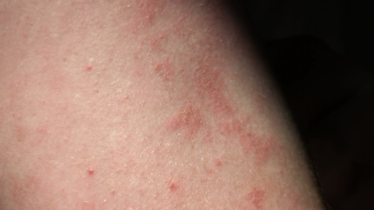 На цефтриаксон аллергия чем заменить — Аллергия и все о ней