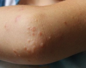 Аллергия на локтях и их сгибах: причины и что делать