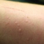 Аллергия на стиральный порошок: причины и симптомы (с фото)