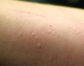 Аллергия на стиральный порошок: причины и симптомы (с фото)