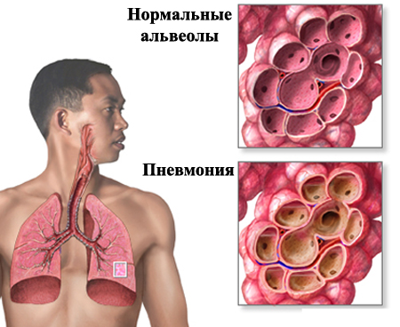 Вид пневмонии