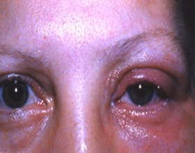 Аллергический блефарит — симптомы, причины и как лечить