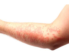 Аллергия на коже у взрослых: причины, виды, формы и осложнения