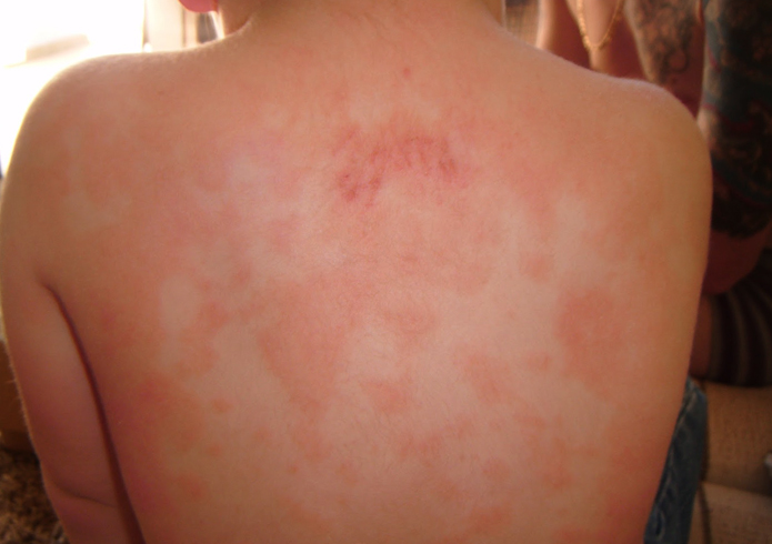 Аллергическая экзема на спине
