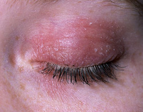 Аллергия на веках глаз: причины, симптомы и лечение, фото