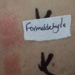 Аллергия на формальдегид: причины, симптомы и что делать