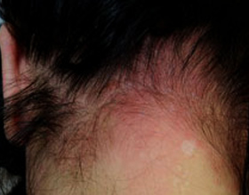 Аллергия на краску для волос: как проявляется, фото и что делать
