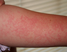 Аллергия на жару: симптомы, причины появления и что делать