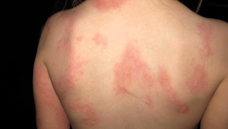 Может ли быть аллергия на энтерофурил у ребенка thumbnail