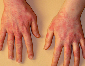Аллергия на латекс у женщин и мужчин: симптомы и что делать