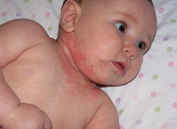 У малыша аллергия