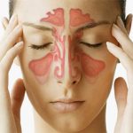Аллергический синусит: причины, симптомы, чем и как лечить
