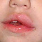 Отек губы при аллергии: причины и как его снять