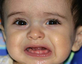 Аллергия при прорезывании зубов: может ли быть, симптомы и что делать