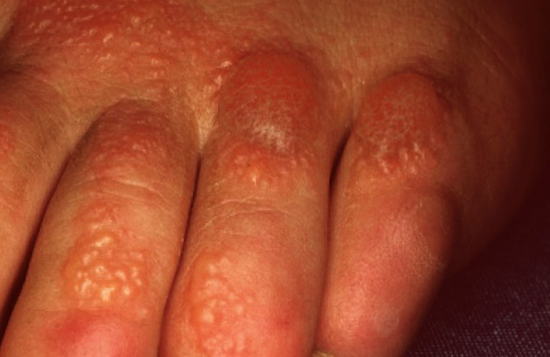 Пузырчатый дерматит на руке