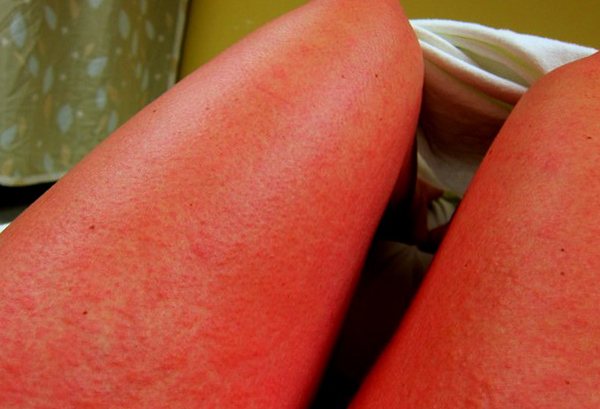 Аллергическая сыпь на ногах