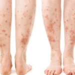 Аллергия на ногах у детей и взрослых: причины, симптомы и что делать