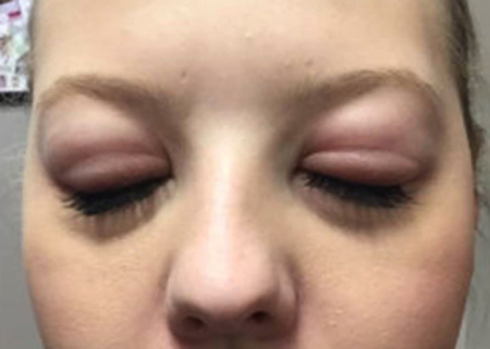 Опухли глаза от аллергии